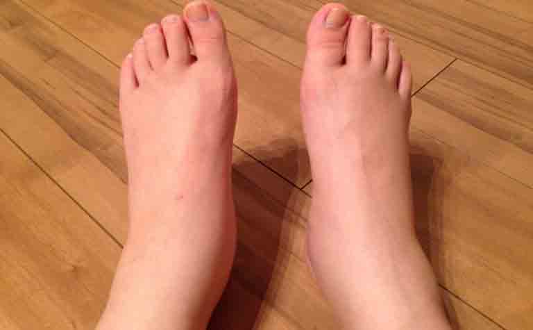 糖尿病とむくみ